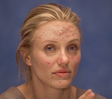 Cameron Diaz Acne Scars